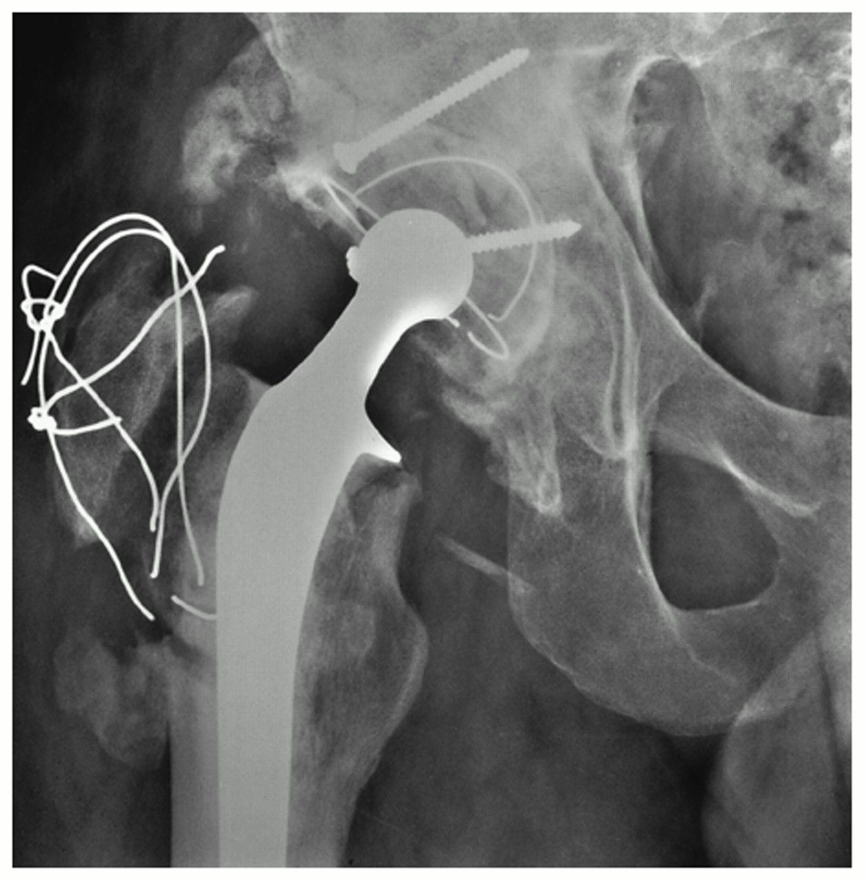 Surgical Approaches in Total Hip Replacement - Mr Ilan Freedman - Melbourne  Orthopaedic Surgeon